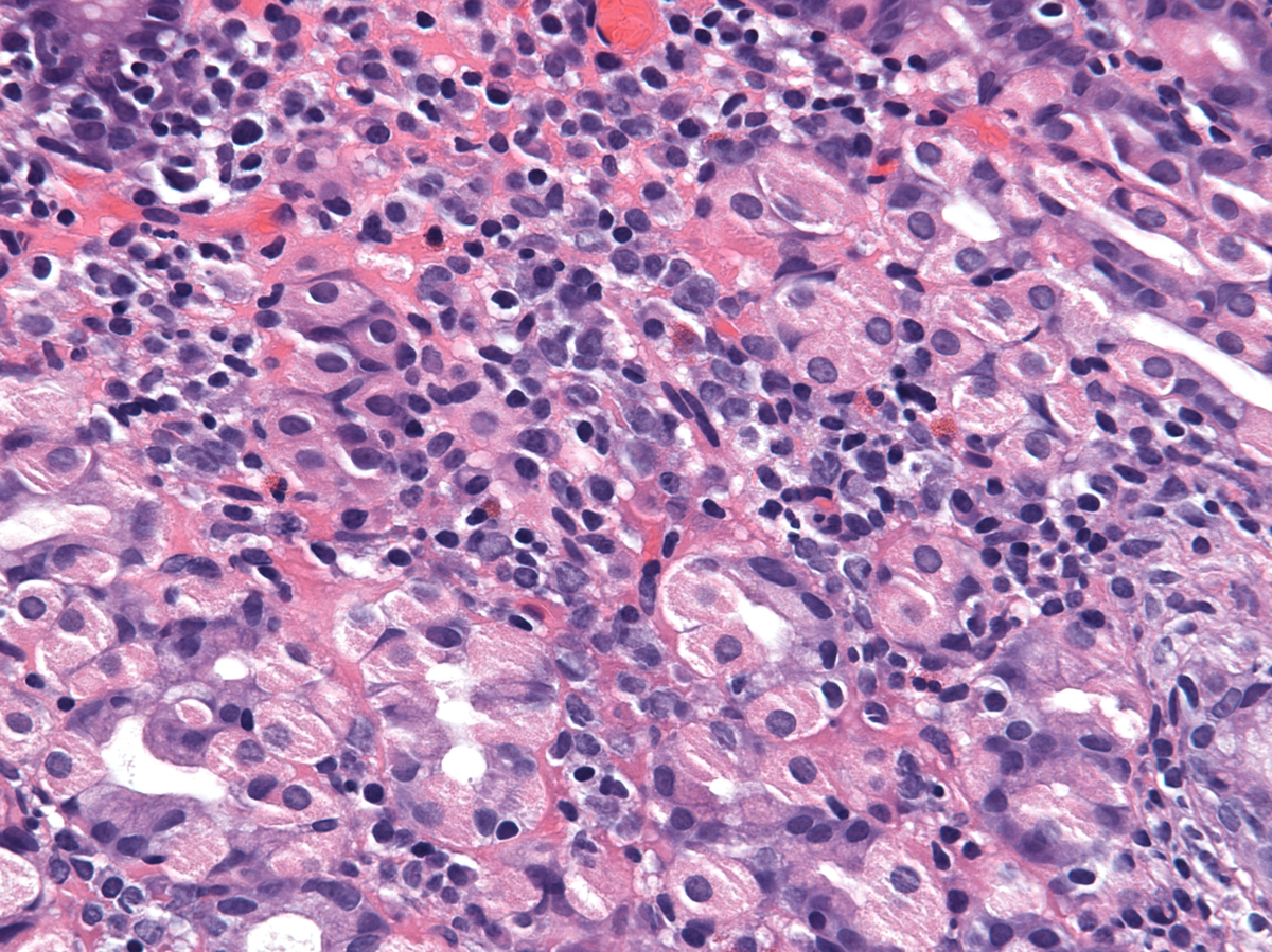 gastric erosion, H&E, 40x, atypical large cell infiltrate within gastric mucosa admixed with eosinophils